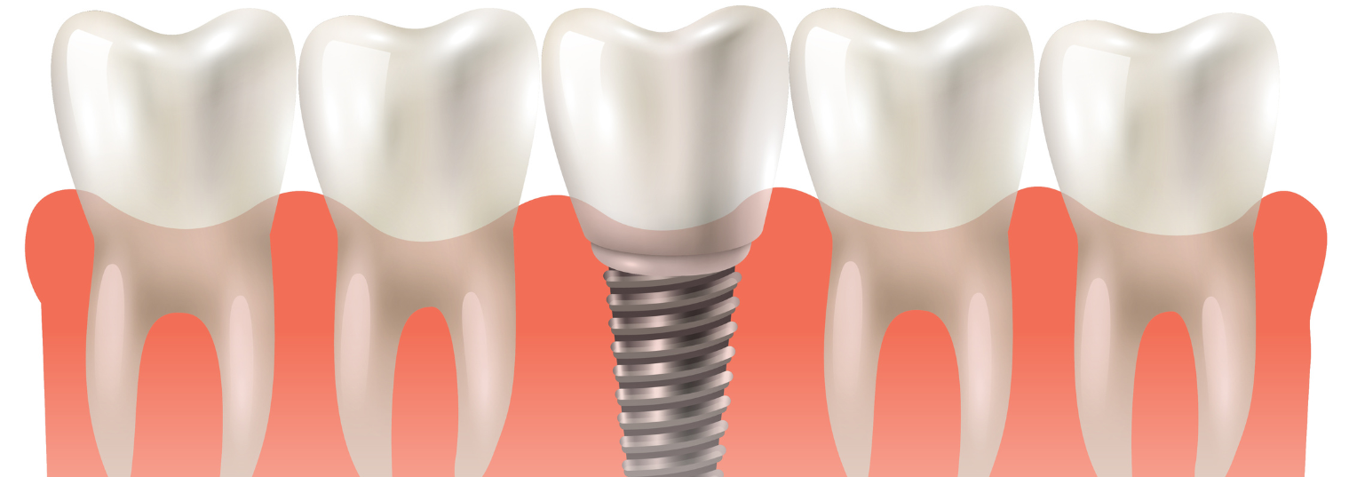 Dental Implants at Bandra