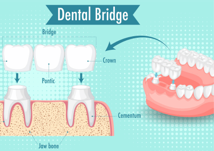 Dental crowns and bridges