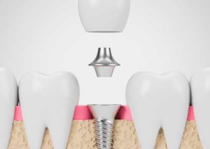 Dental Implant Treatment