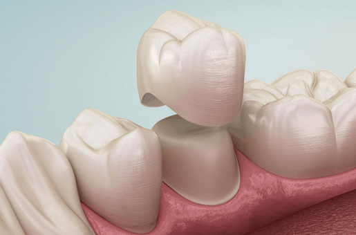 Dental Crown treatment