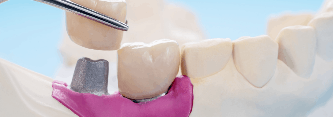 Dental Crown Treatment