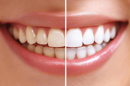 Teeth Whitening