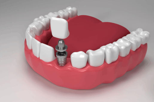 Dental Implant