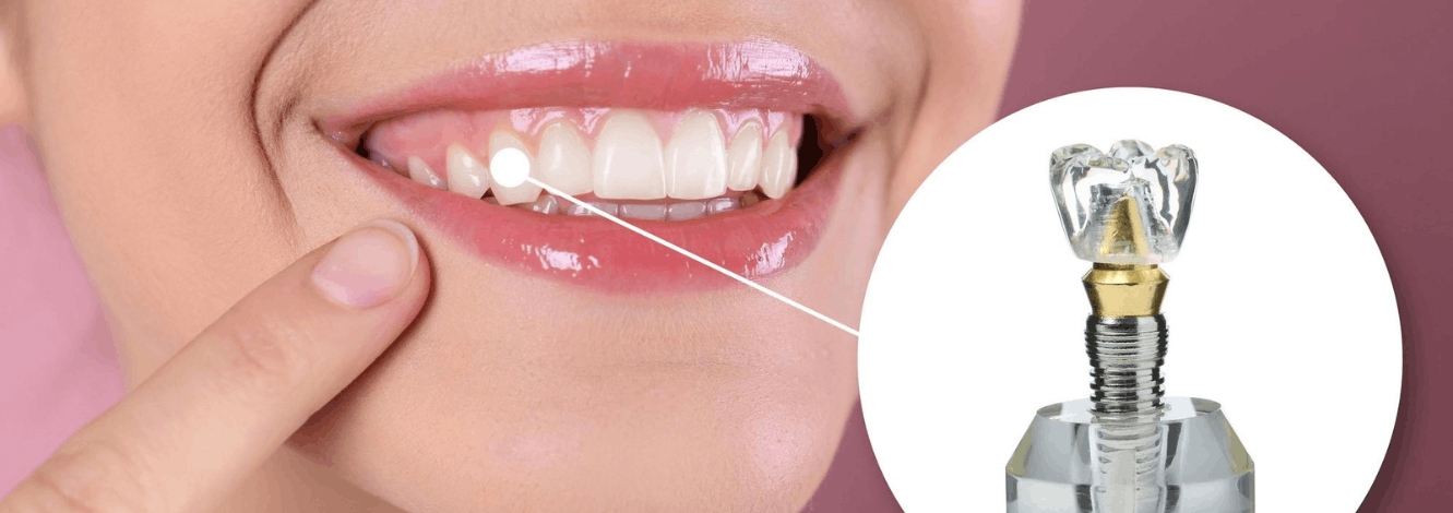 Dental Implant