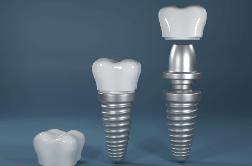 Dental Implant