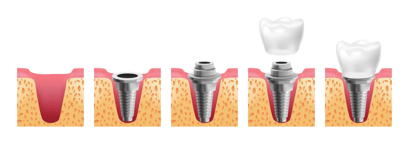 Dental Implant