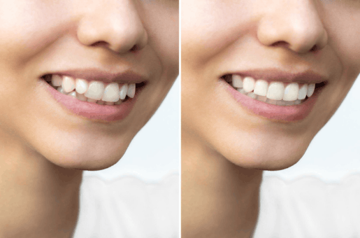 Smile makeover
