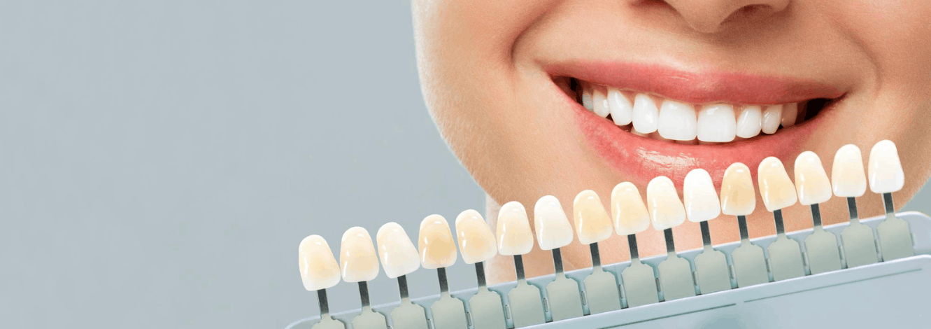 Smile Makeover