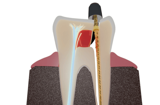 Root Canal Treatment