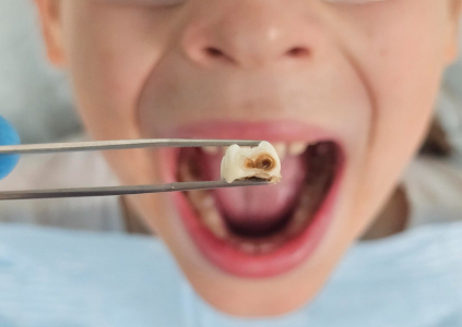 cavities in milk teeth