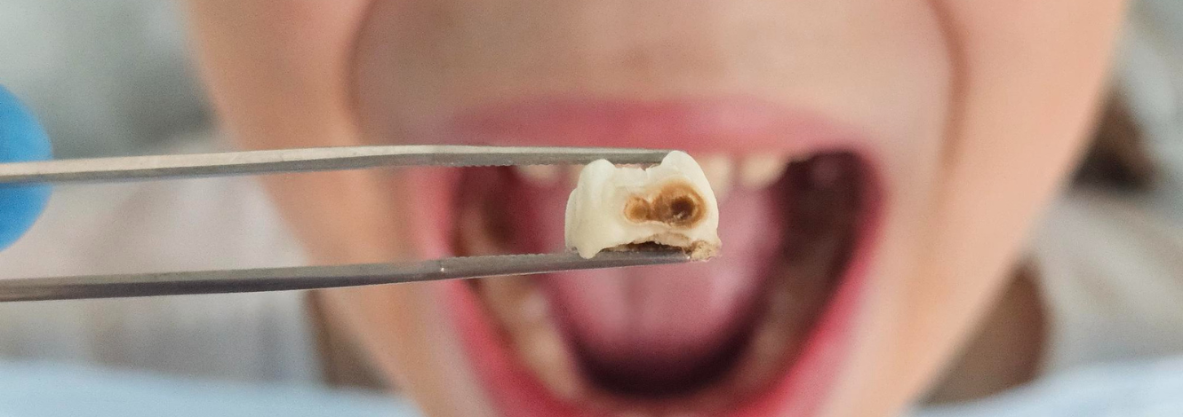 Cavities in milk teeth