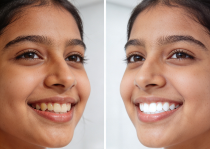 Teeth Bleaching