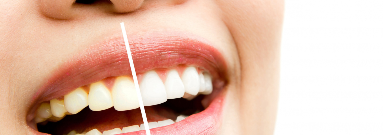Professional Teeth Whitening