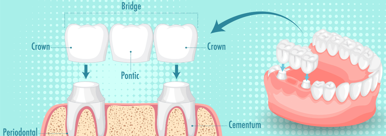 Dental crowns and bridges