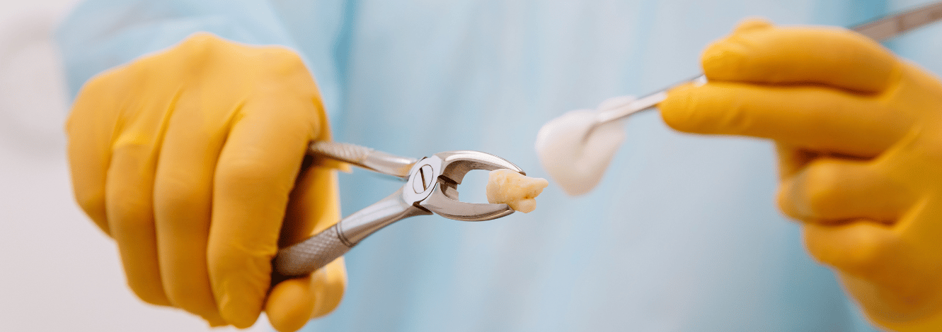 tooth extraction